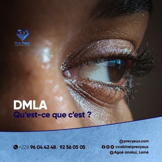 LA DMLA ou la Dégénérescence Maculaire Liée à l’Age